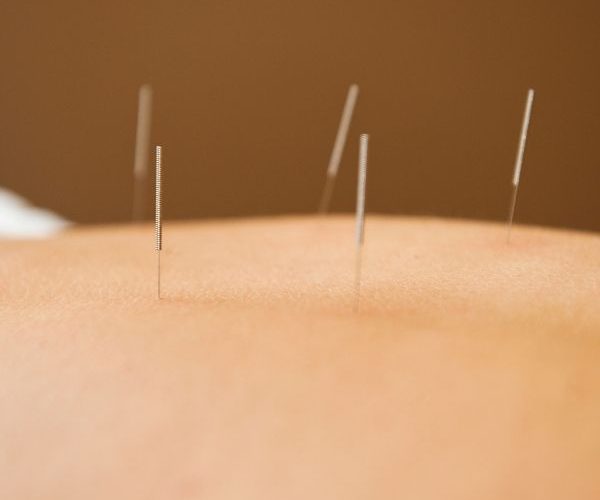 Acupuncture and Herbal Medicine (1)